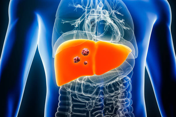 Liver Cancer