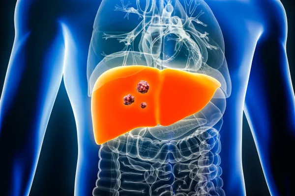 Liver Cancer