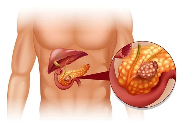 Pancreatic Cancer