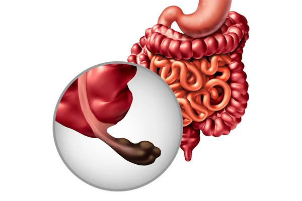 Appendix Cancer