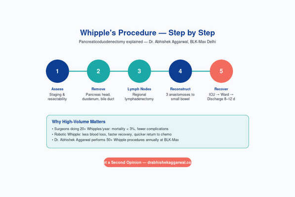 Whipples Procedure