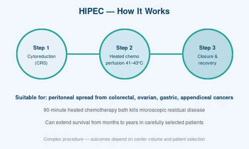 HIPEC Surgery A New Hope for Peritoneal Cancer Patients