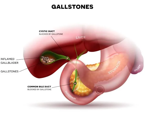 Say Goodbye to Kidney Stone Pain